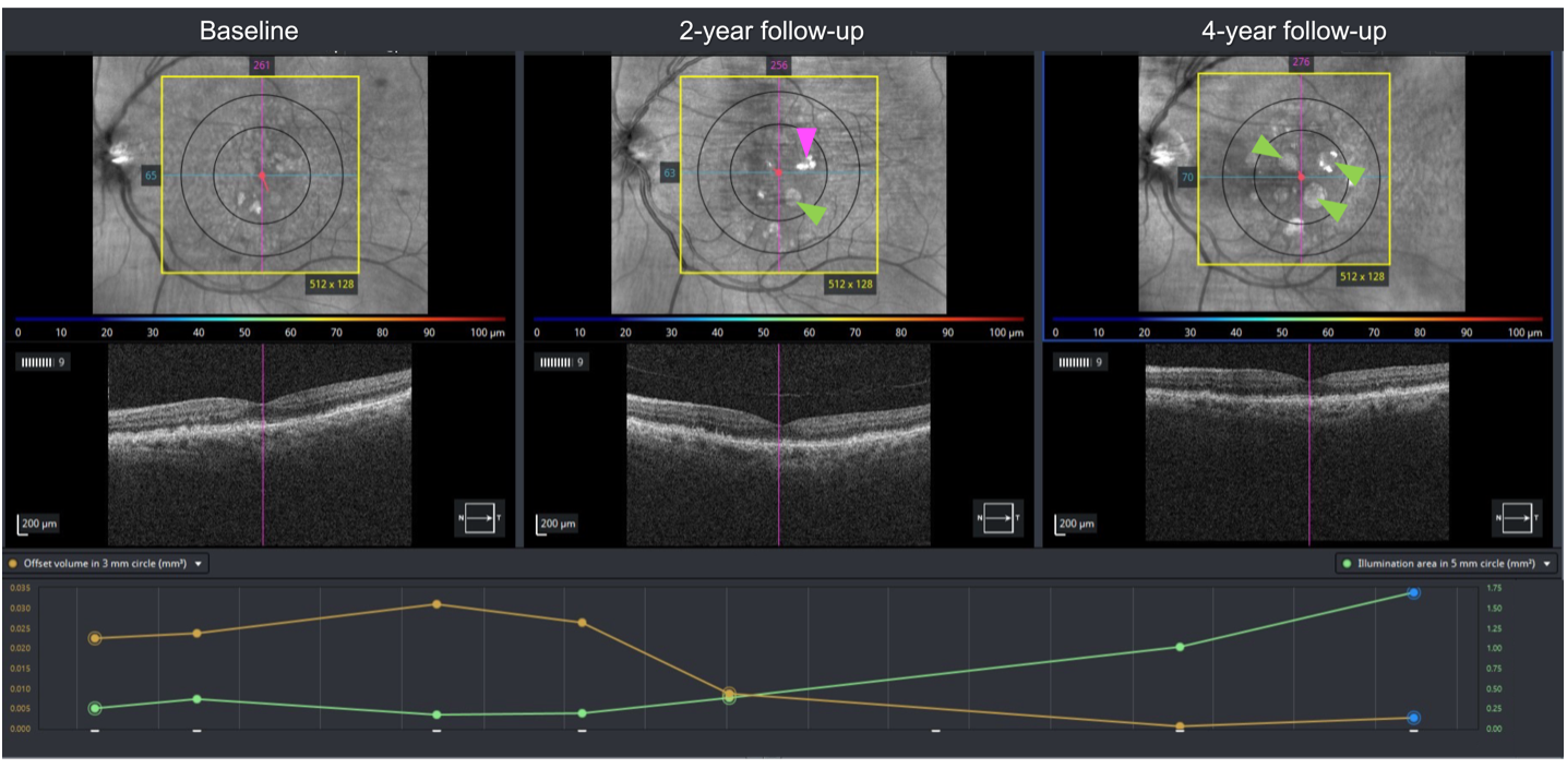 Figure 6. Trend-based analysis of geographic atrophy progression in the left eye over 4 years. Top row: Serial near-infrared reflectance imaging (NIR). Development of GA represented by round hyperreflective lesions (green arrowheads) is noted at the 4-year follow-up. An irregular highly reflective lesion (pink arrow) is appreciated at the 2-year follow-up which is correlated with a hyperreflective crystalline deposit on optical coherence tomography. At the 4-year follow-up, this area develops GA; Middle row: serial cross-sectional optical coherence tomography through the fovea. Bottom row: Cirrus Advanced RPE trend analysis (Carl Zeiss
Meditec, Inc., Dublin, CA, USA). Orange line: RPE elevation volume (correlate of drusen volume) within the central 3mm. Green line: sub-RPE illumination area (correlate of cRORA choroidal hypertransmission area) within central 5mm. RPE: Retinal pigment epithelium. cRORA: complete RPE and outer retina atrophy. Drusen volume at baseline was moderate,
0.02mm3. Central drusen volume increased to 0.03mm3 at the 1-year follow-up and subsequently decreased as the area of cRORA increased.