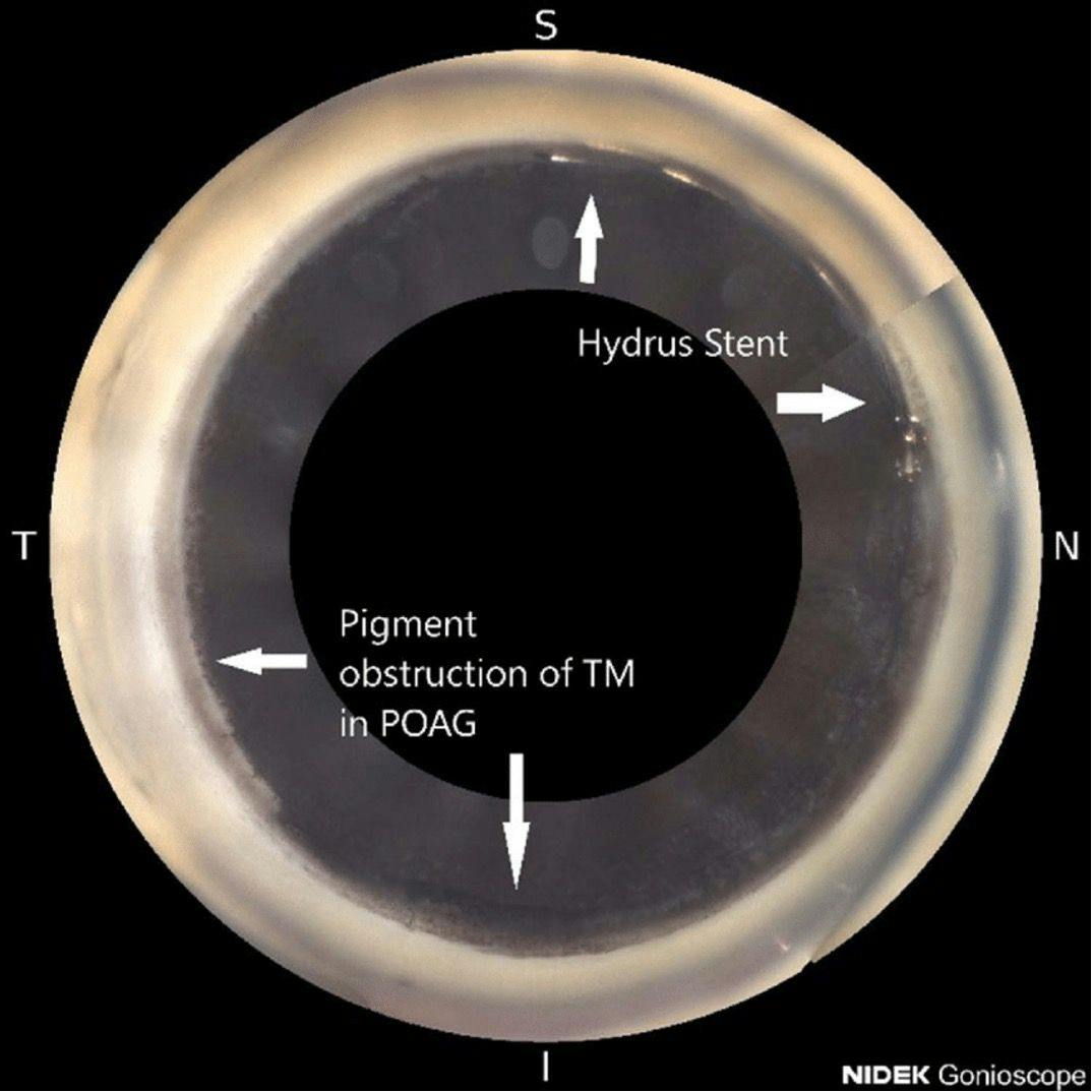 Figure 1. Pigment obstruction of the trabecular meshwork (TM) with a Hydrus stent, image with NIDEK Gonioscope