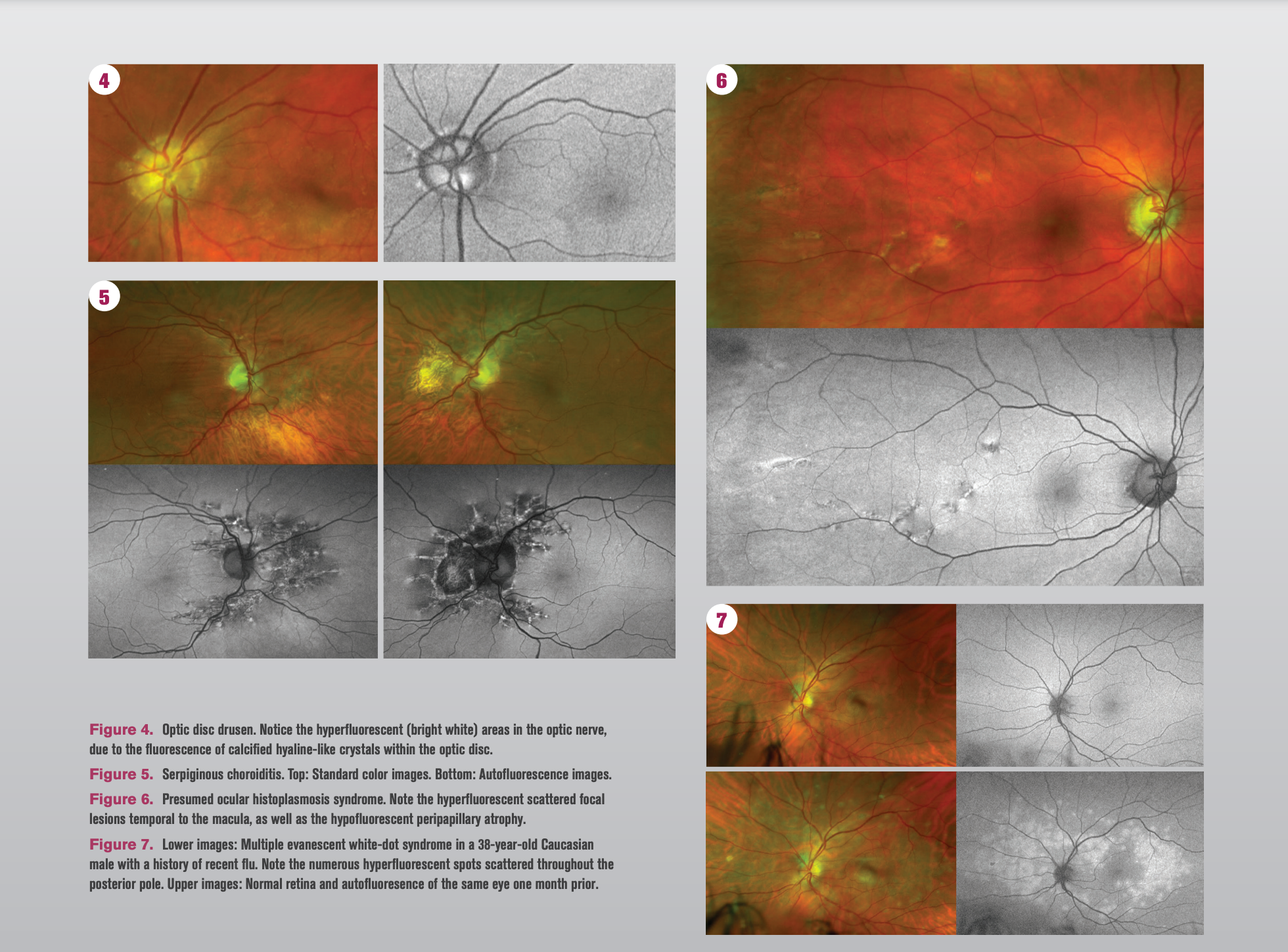 Imaging helps to identify retinal disease