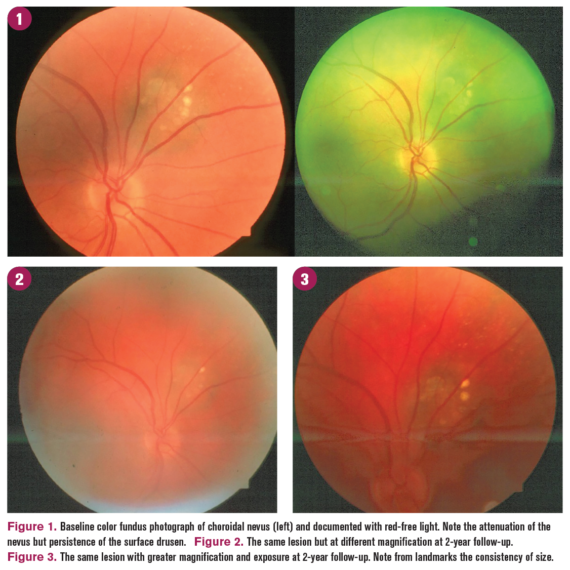 How to differentiate between choroidal nevus and choroidal melanoma
