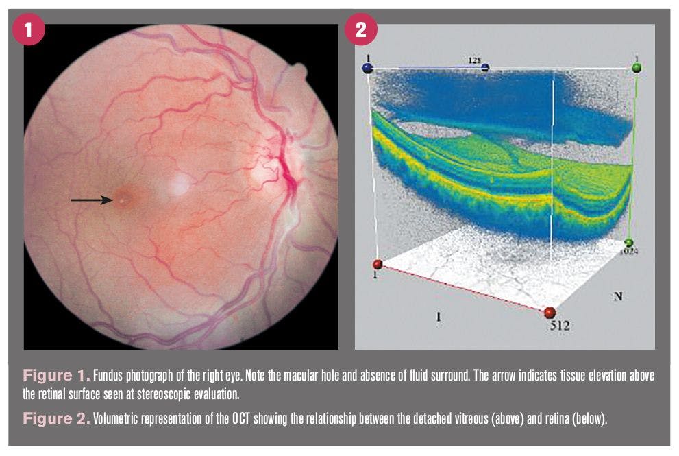 Case: New protocol for macular hole treatment