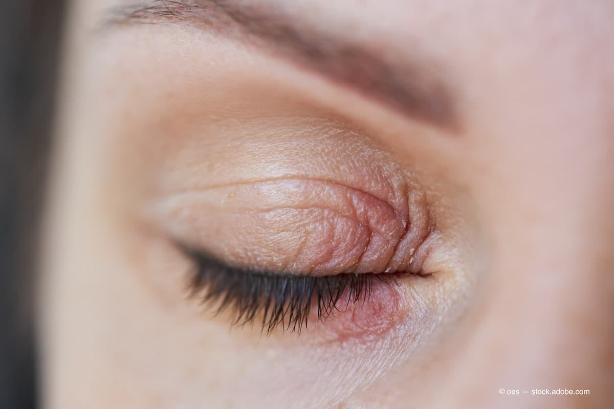 Peeling and swelling on the eyelid of the human eye (Adobe Stock / oes)