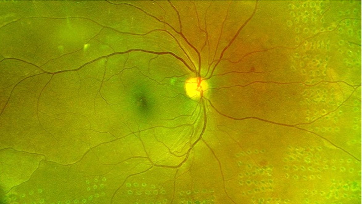 Role of comorbidities in management of diabetic retinopathy
