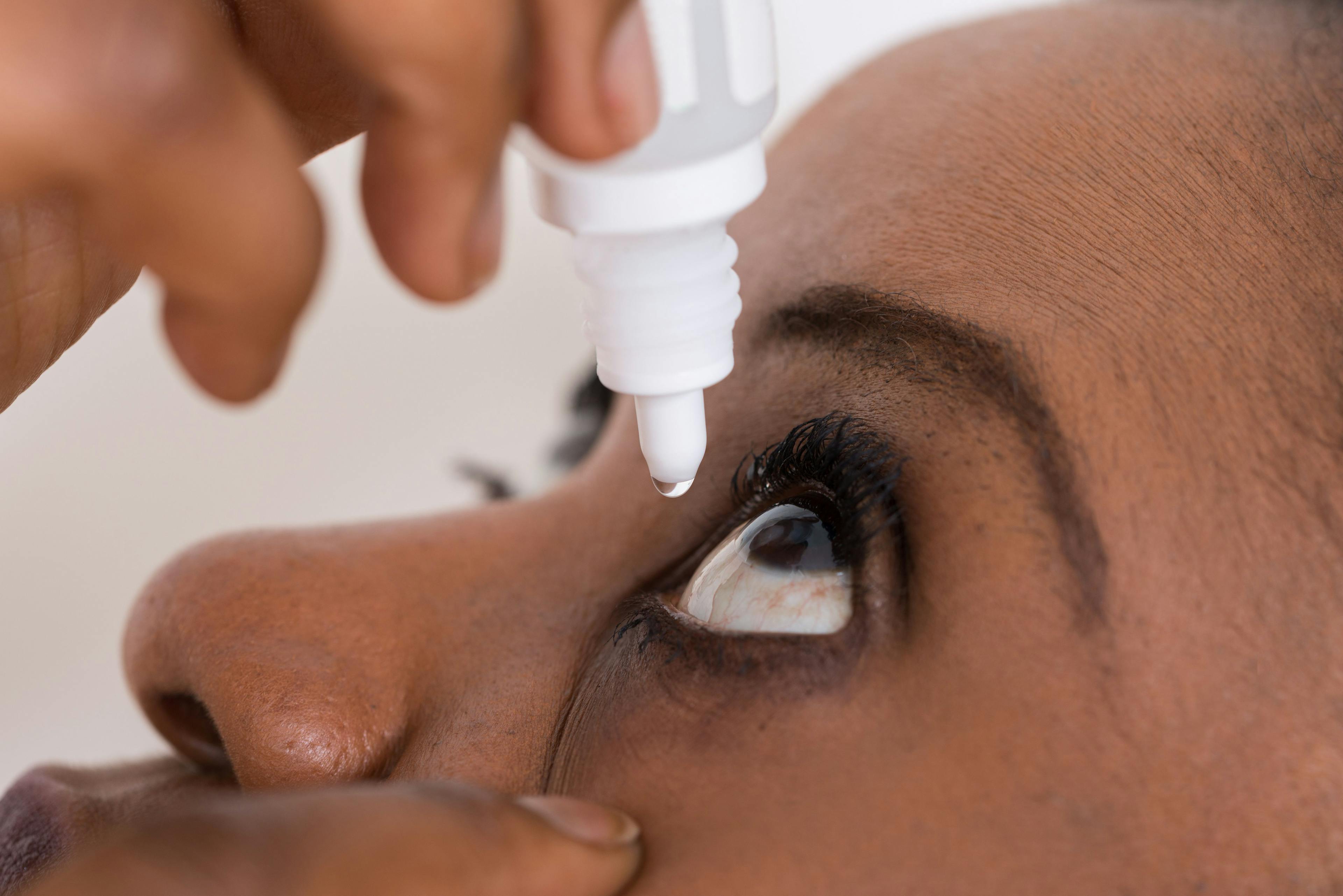 Optimizing management of dry eye disease