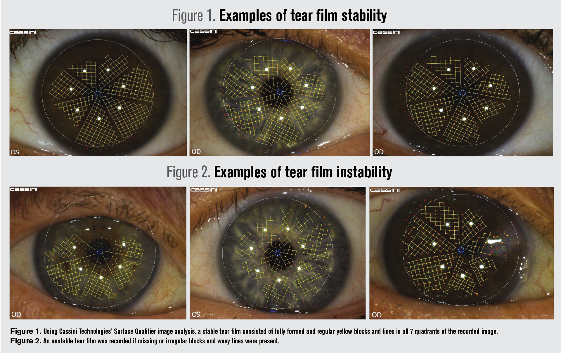 How the tear film affects IOL measurements