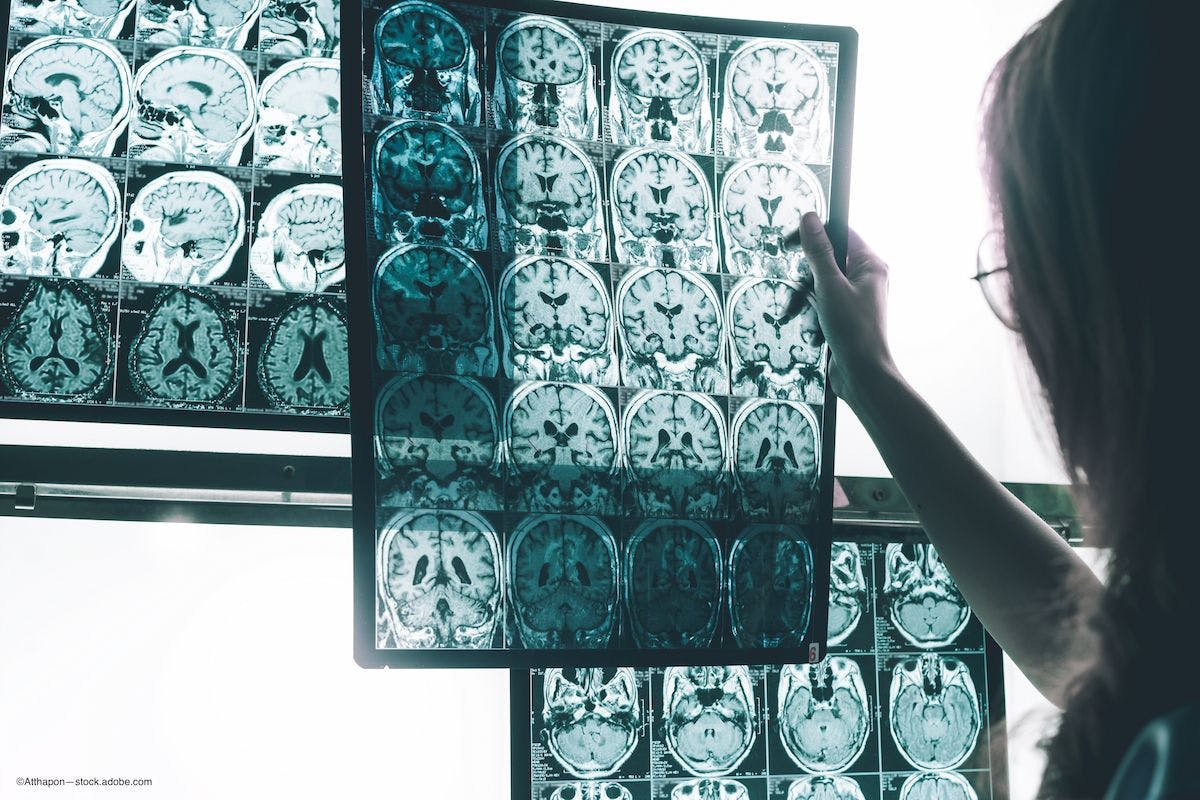 neurologist looks at brain scans of patient with Alzheimers, which may coincide with AMD - Image credit: Atthapon—stock.adobe.com
