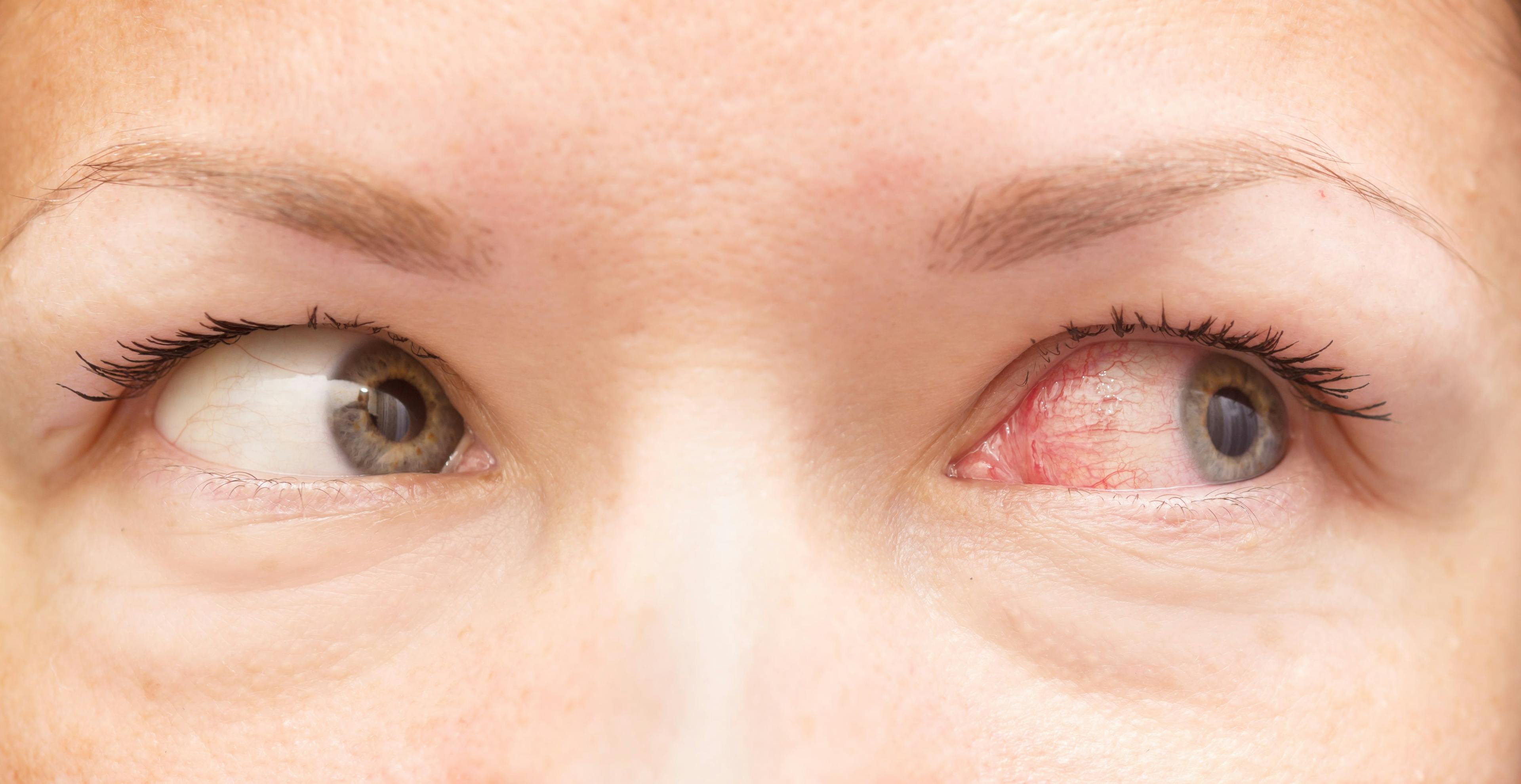 Peer-reviewed literature answers 3 questions about COVID-19 and conjunctivitis