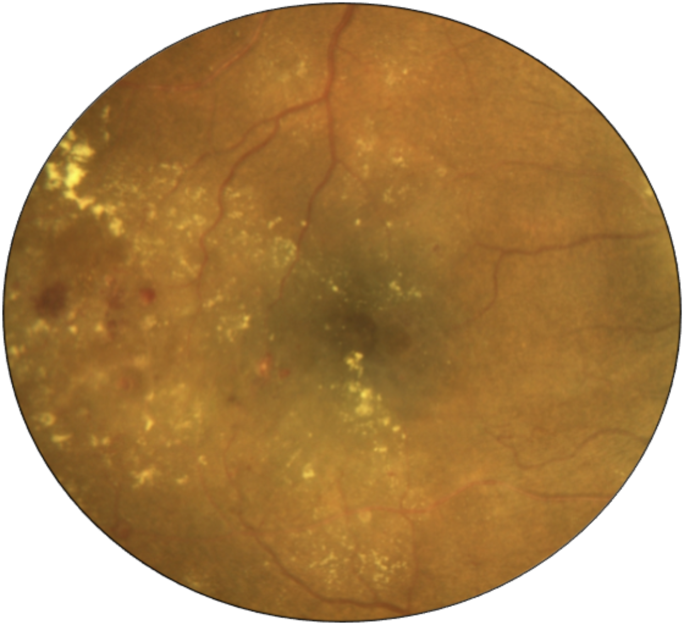 Diabetic retinopathy clinical pearl pictorial