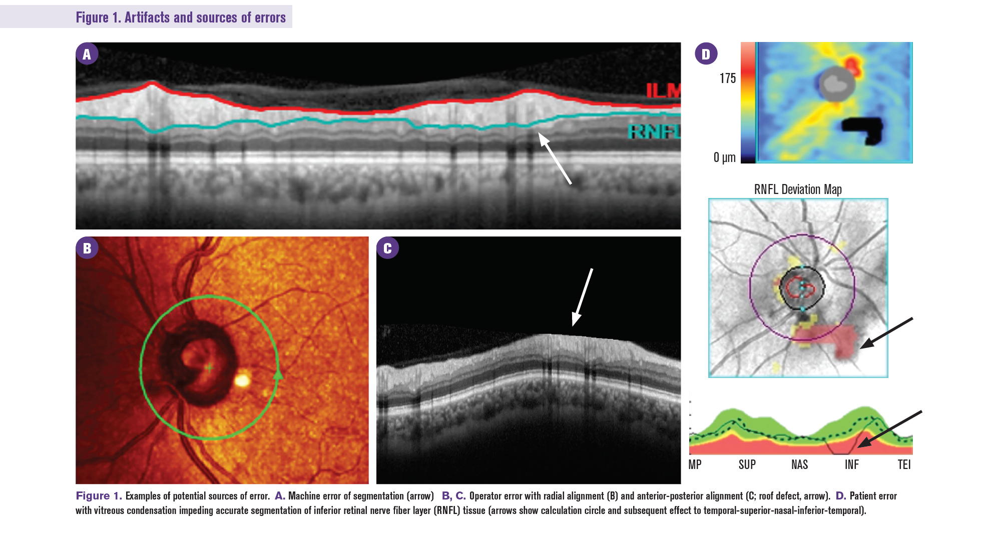 OCT in glaucoma management: Green isn’t always clean