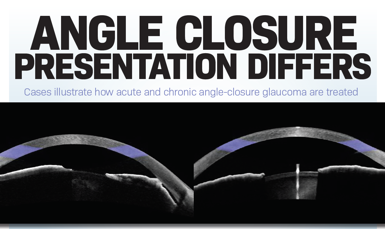 Angle closure presentation differs