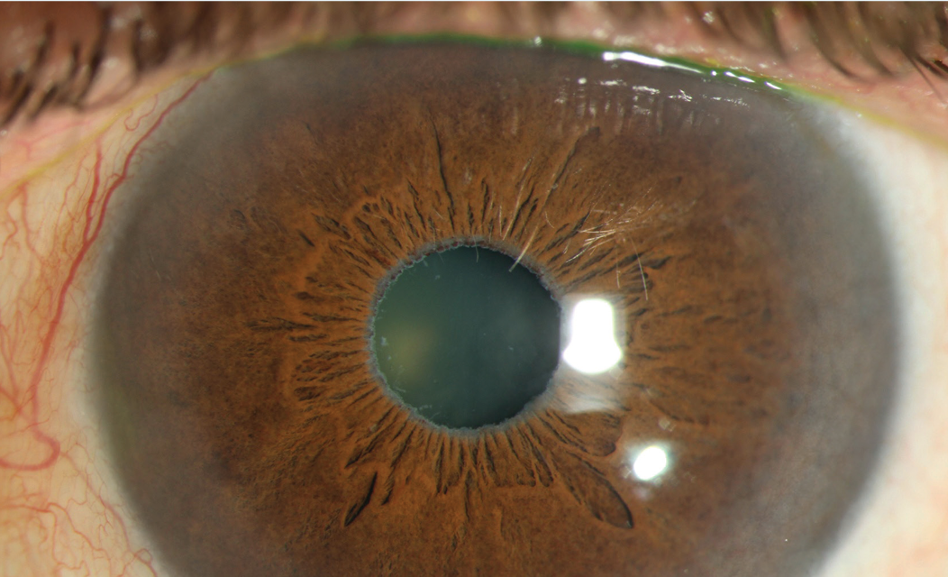 Peripupillary prognosticators of glaucoma