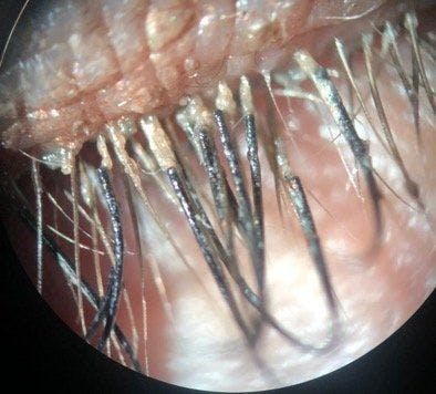 Blog: A case of Demodex infestation with eyelash extensions