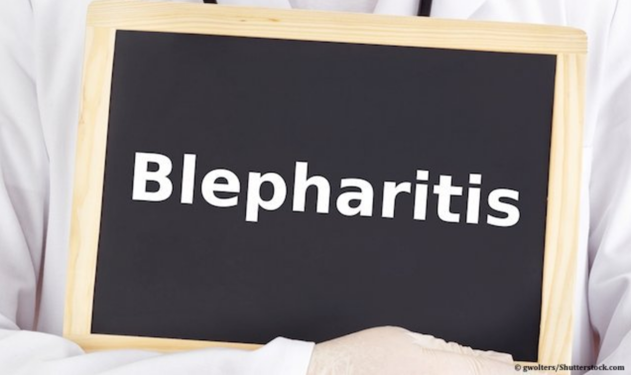 Hidradenitis suppurativa masquerades as blepharitis