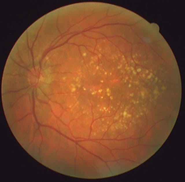 Dry age-related macular degeneration: The second city of AMD