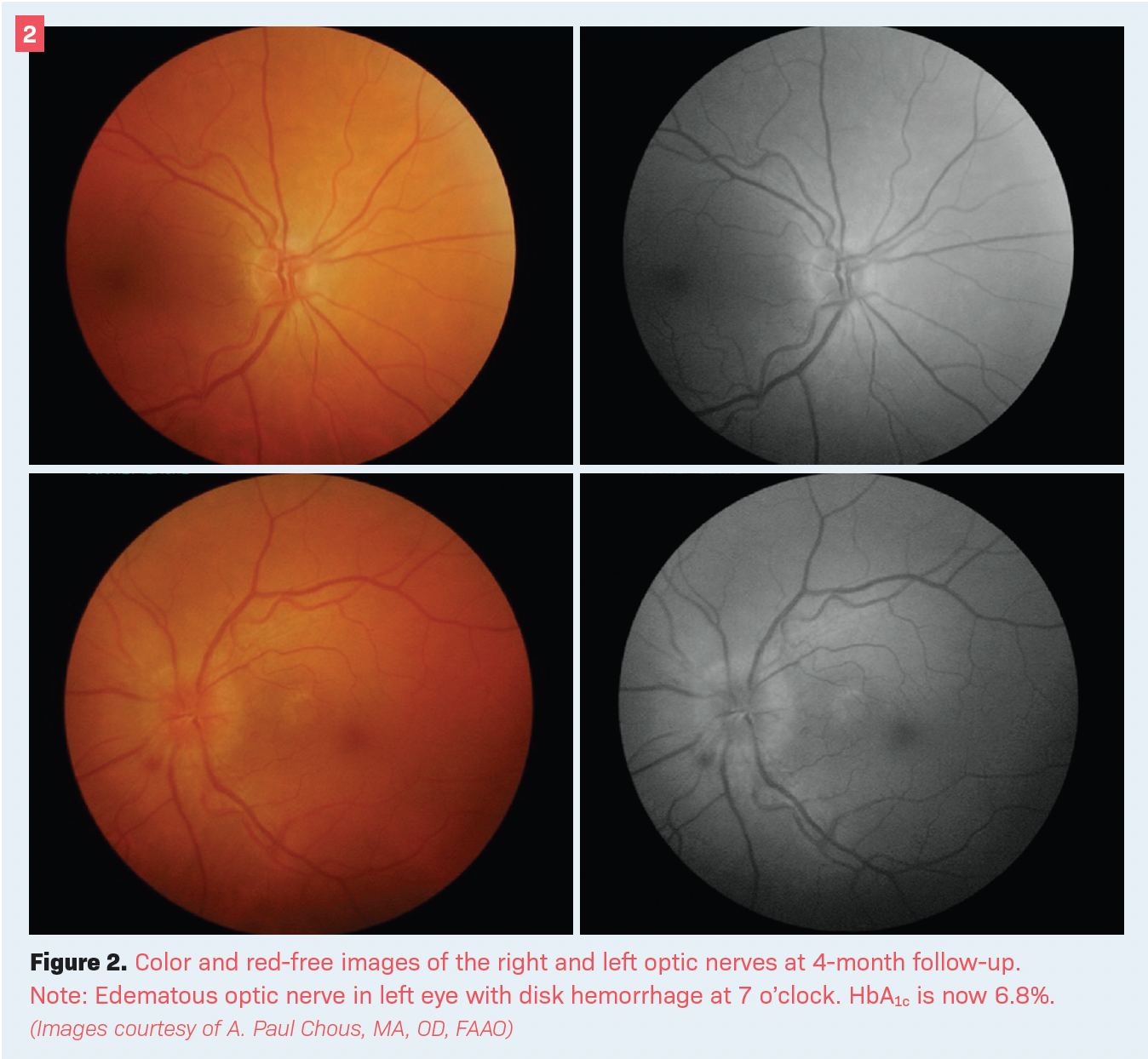Optic disk swelling in an asymptomatic patient with diabetes