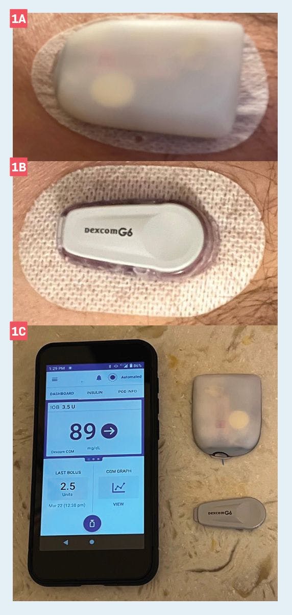 Figure 1. Example of an automated insulin delivery system combining a tubeless insulin pump (a) with a continuous glucose sensor (b) and an artificial intelligence algorithmic display (c) with key metrics like current blood glucose, blood glucose change rate (arrow on display), insulin on-board (IOB; unutilized active insulin within the patient based on drug half-life), and last bolus delivered. (Images courtesy of A. Paul Chous, OD, MA, FAAO)