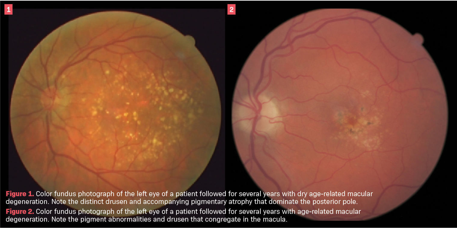 Figure 1. Color fundus photograph of the left eye of a patient followed for several years with dry age-related macular degeneration. Note the distinct drusen and accompanying pigmentary atrophy that dominate the posterior pole.   Figure 2. Color fundus photograph of the left eye of a patient followed for several years with age-related macular degeneration. Note the pigment abnormalities and drusen that congregate in the macula.  