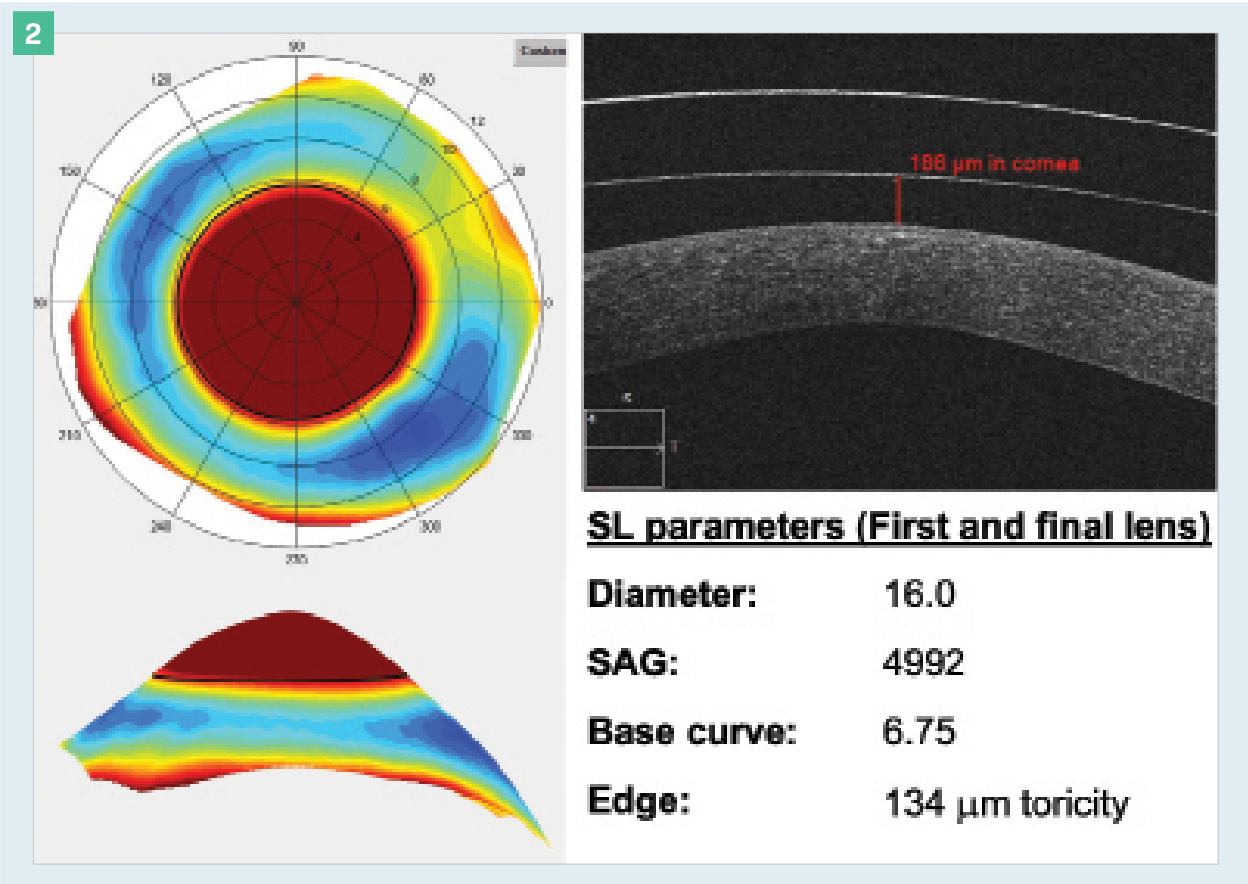 Figure 2.Scleral Topography. Using scleral topography to design a scleral lens (SL) can take the estimation out of the fitting process and allow for a more precise and well-fitted lens from the start. The scleral topography here shows oblique asymmetries (cool colors indicate relative depression and warmer colors indicate relative elevation), which were measured and accommodated with 134 μm of edge toricity. The first lens was well fitted, aligned in the periphery with about 190 μm of apical clearance.