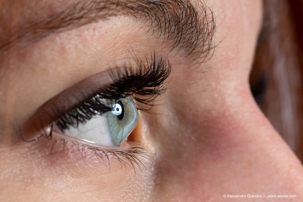 Female eye affected by keratoconus, or conical cornea (Adobe Stock / Alessandro Grandini)
