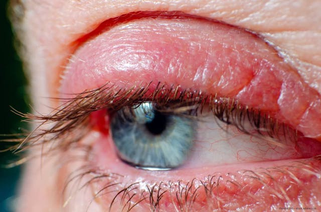 Inflamed red eyelid due to Demodex blepharitis