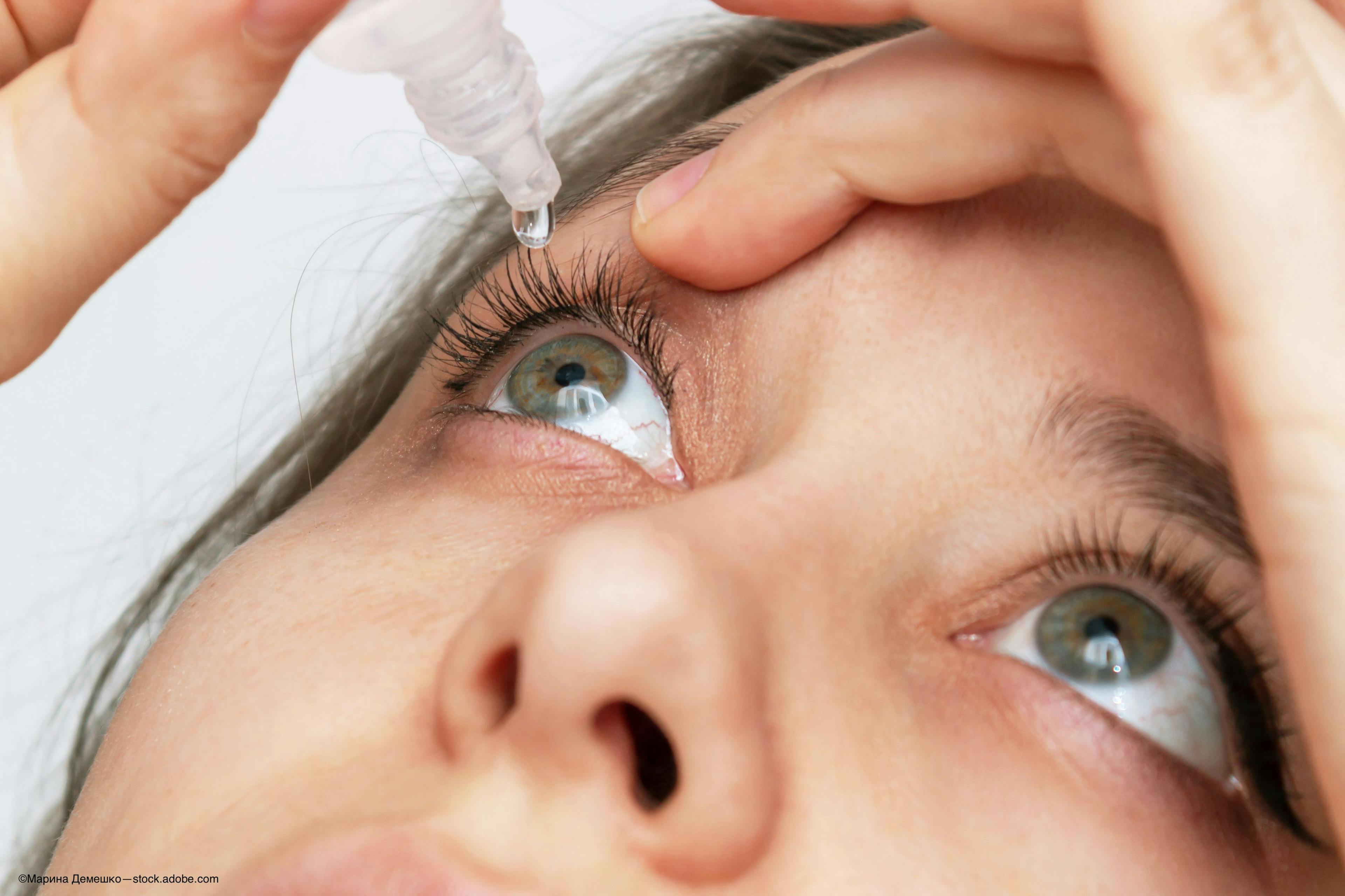 eye drop OK-101 ophthalmic solution instilled in eye for treatment of dry eye disease - Image credit: Adobe Stock / Марина Демешко
