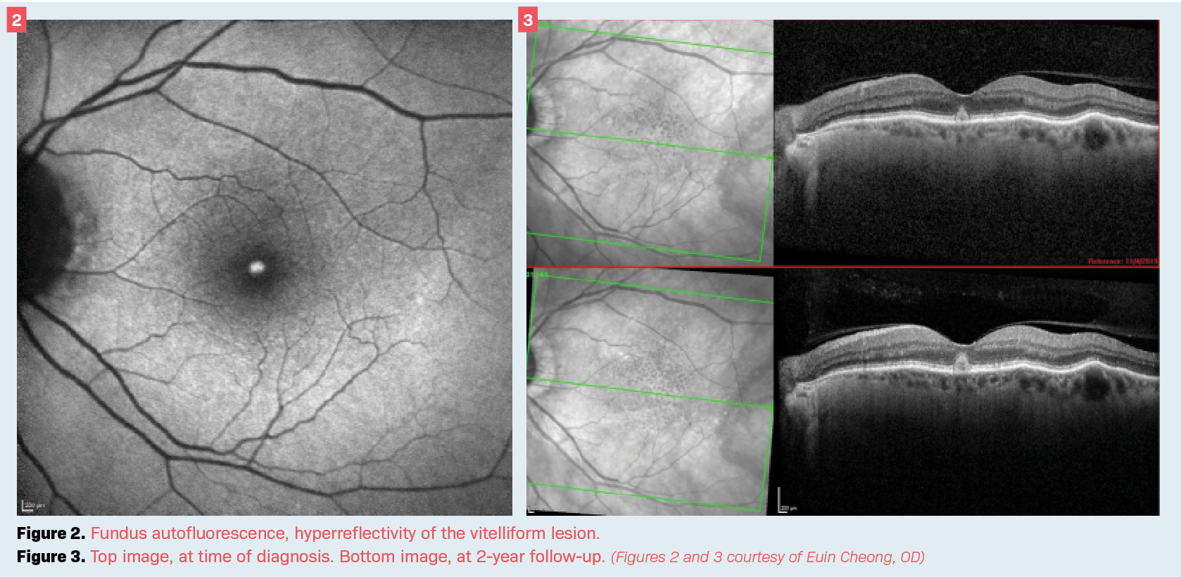 Figure 2. Fundus autofluorescence, hyperreflectivity of the vitelliform lesion.  Figure 3. Top image, at time of diagnosis. Bottom image, at 2-year follow-up. (Figures 2 and 3 courtesy of Euin Cheong, OD)