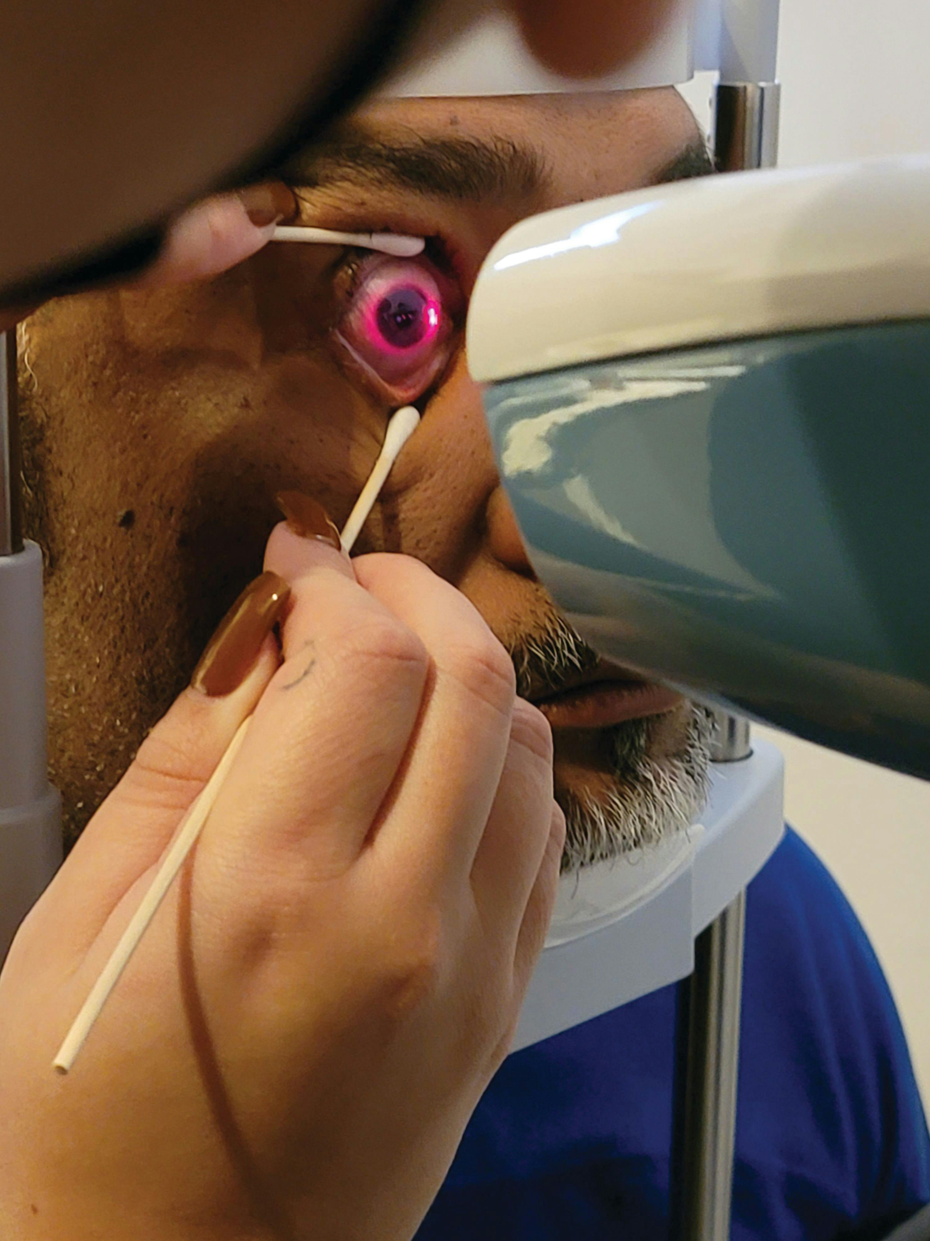 Figure 2. The profilometry method of receiving topographical data about the sclera holds valuable information for initial lens selection because it instantly provides sagittal height and a detailed description of the sclera. 