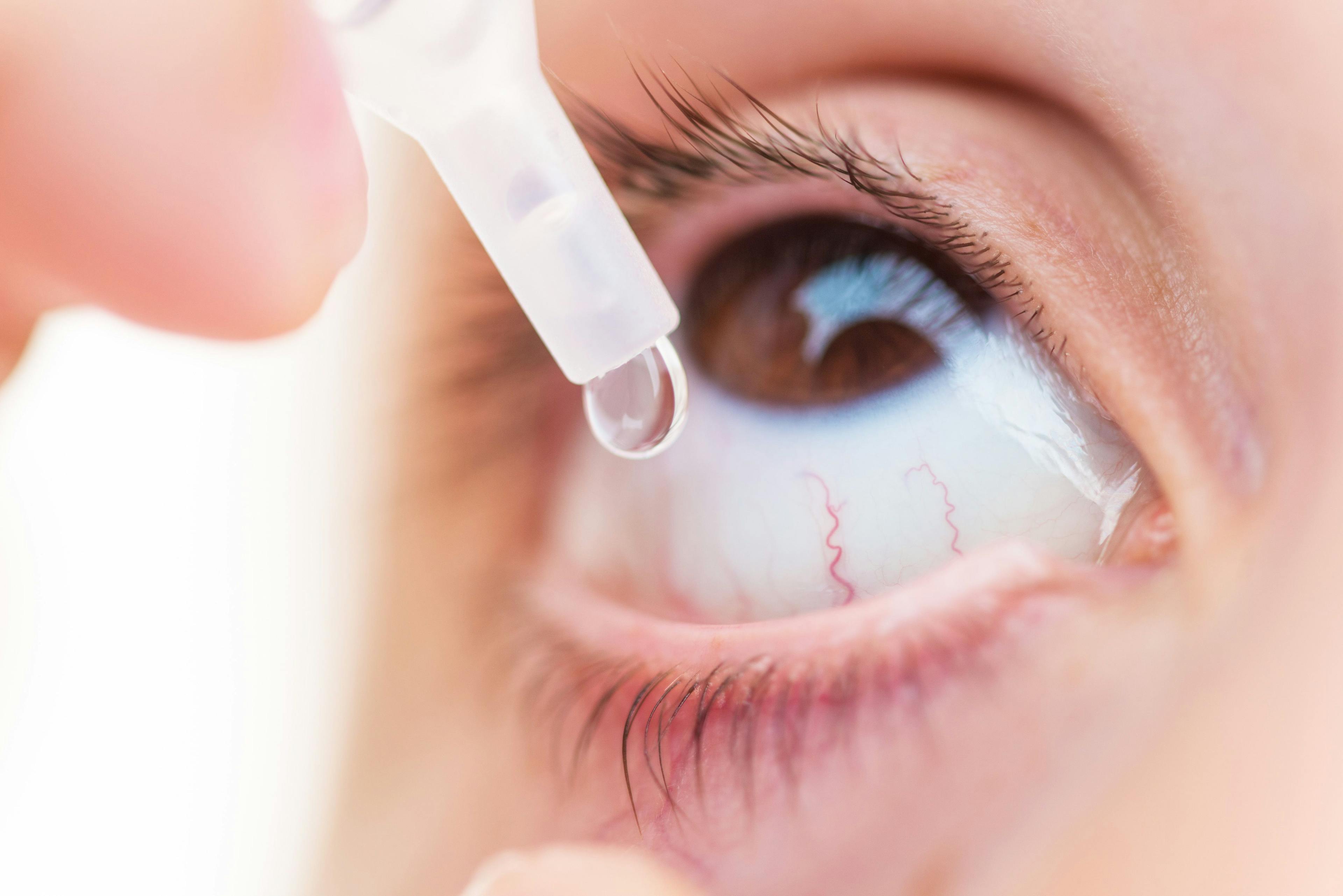 FDA approves Bausch + Lomb Alaway antihistamine eyedrops