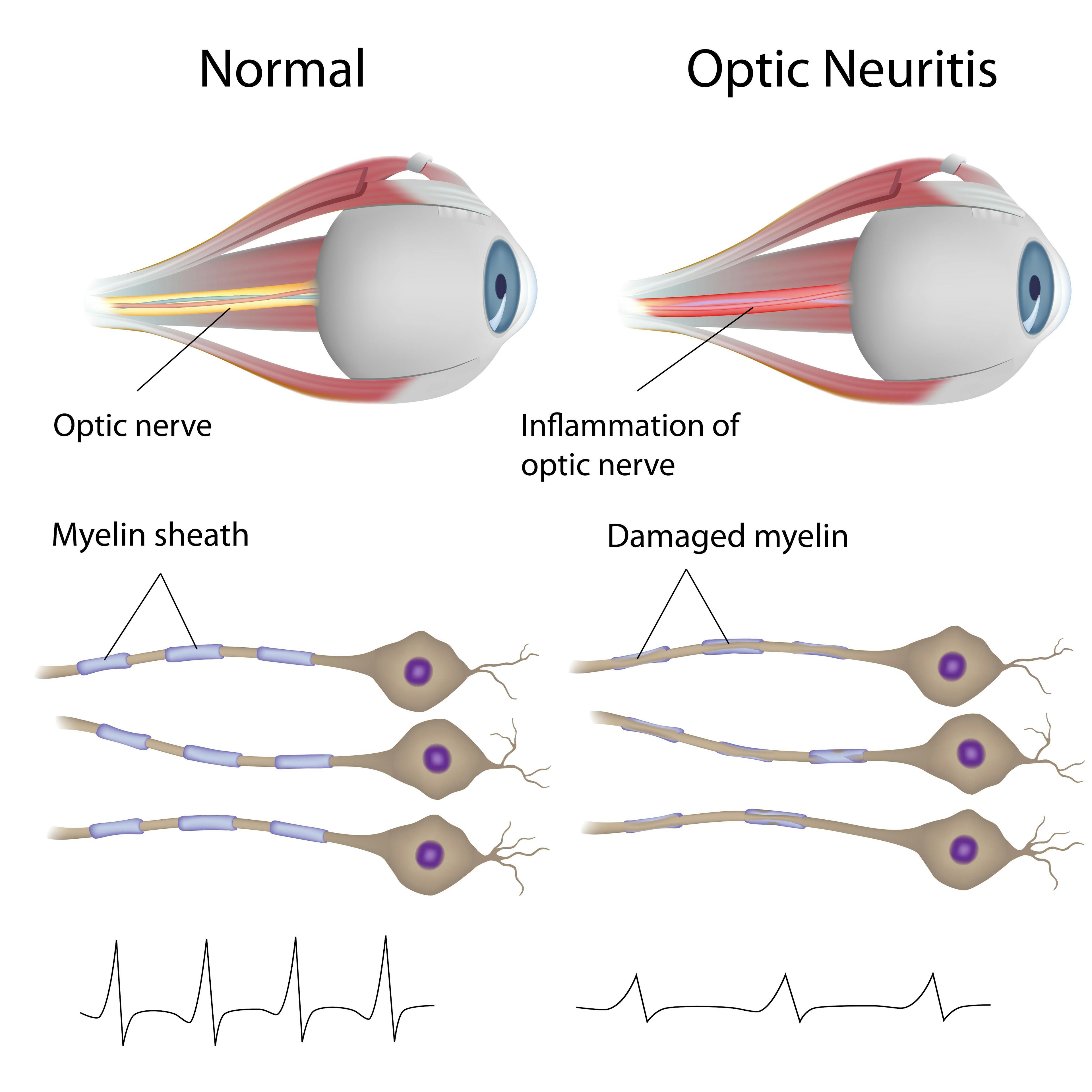 Optic Neuritis and COVID-19 vaccine connection?