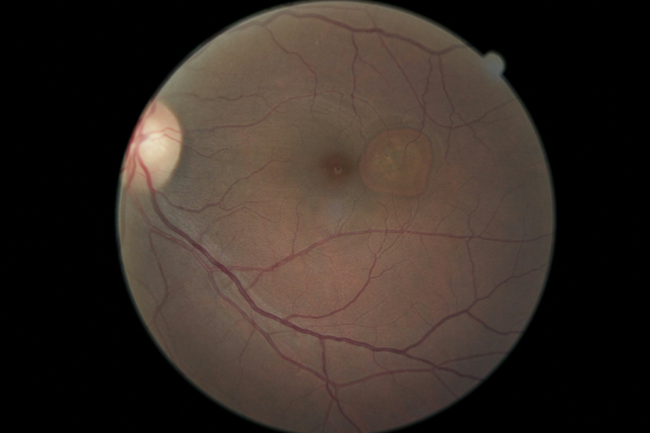 Baseline color fundus photograph (CFP) of the left eye showing extrafoveal retinal pigment epithelial (RPE) detachment.