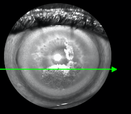 Figure 2. Anterior segment OCT of OD with subepithelial hyper-reflection.