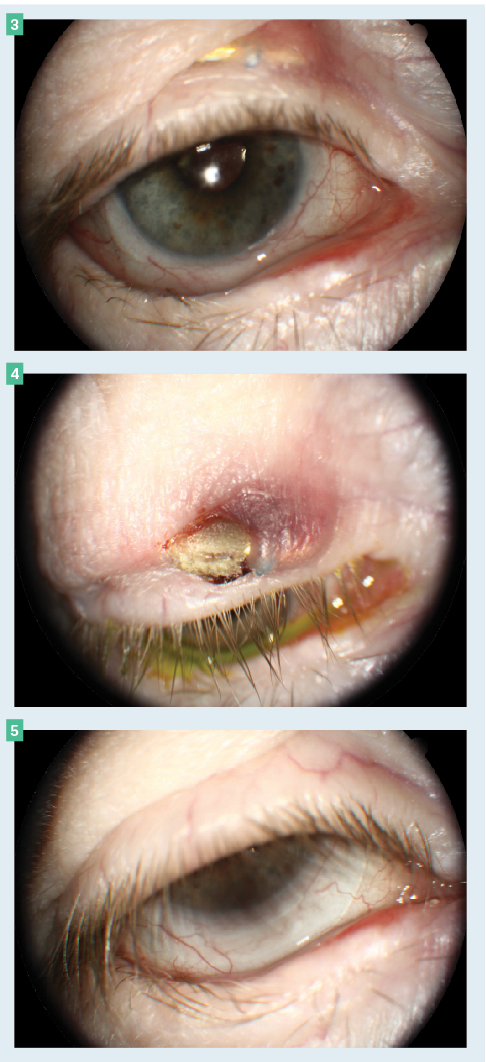 Figure 3. CL with gold weight visible under the right upper eyelid. Lower lid lagophthalmos with trichiasis is also present.  Figure 4. Gold weight on the verge of extruding with overlying scab.  Figure 5. CL healed 2 years later and happily wearing her scleral lens.  (All images courtesy of Jon Bundy, OD)