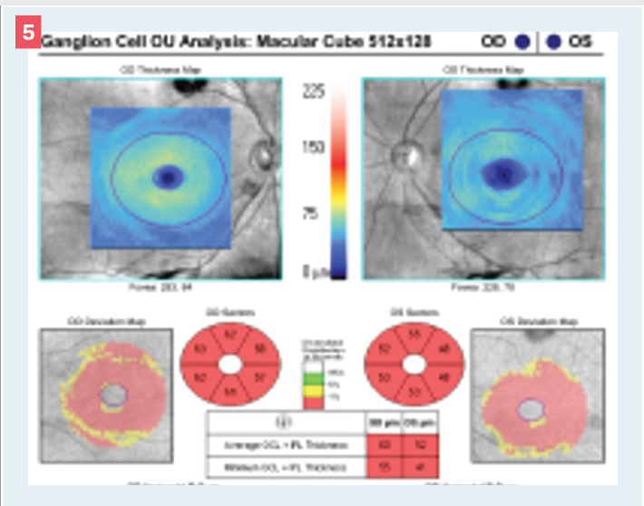 Optical coherence tomography thickness presentation of the ganglion cell analysis. Uppermost panels show extreme thinning based on the color scale. Blue color corresponds to less than 75 µm. The central panel shows significant inner retinal thinning based on the thickness map, as well as the absolute thickness values. The numbers in the 50-µm range represent significant neural tissue loss, leaving supporting structures only.