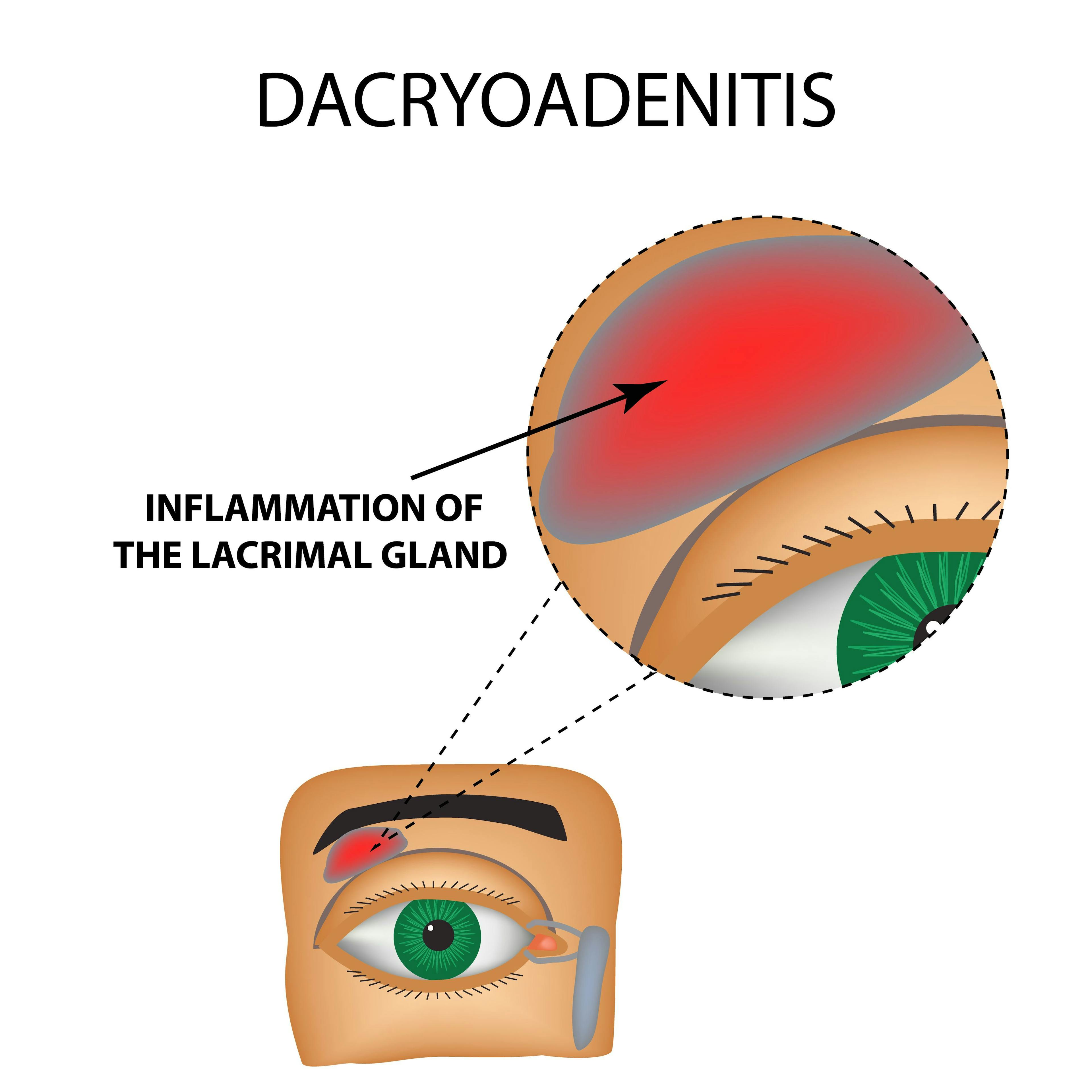 Chronic bilateral dacryoadenitis related to COVID-19