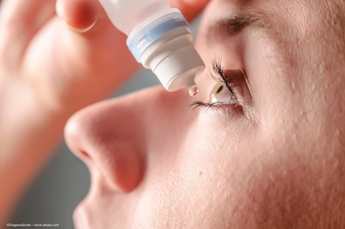 Close up of woman putting eye drops into her eye.