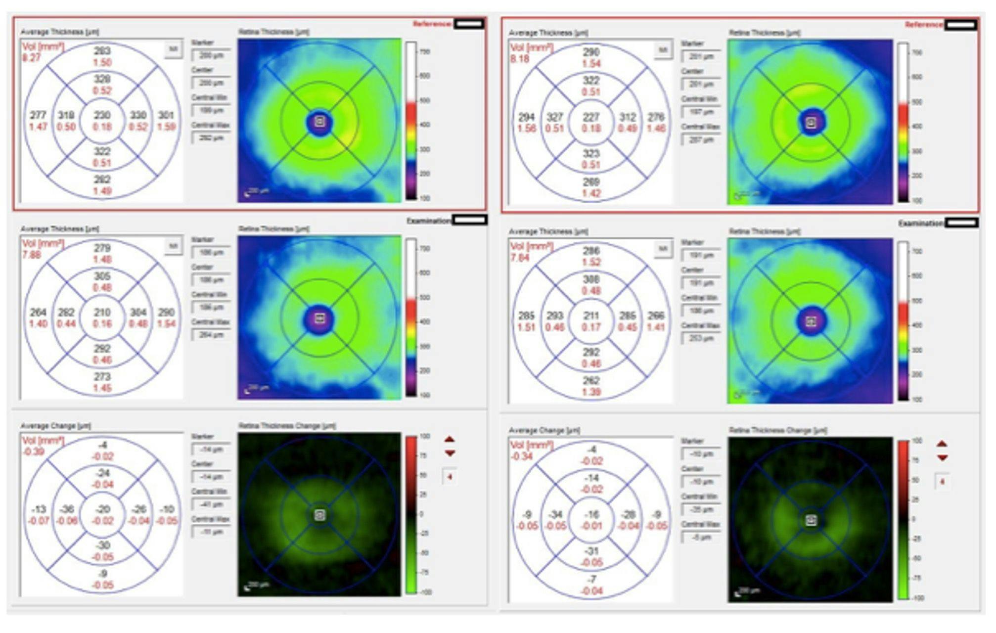 Figure 9. Thickness map of both eyes comparing baseline to follow-up testing and showing change over time. Especially in the inner ETDRS measurement circle, rapid thinning can be seen in both eyes. (All images courtesy of Kyra Dorgeloh, OD, FAAO.)