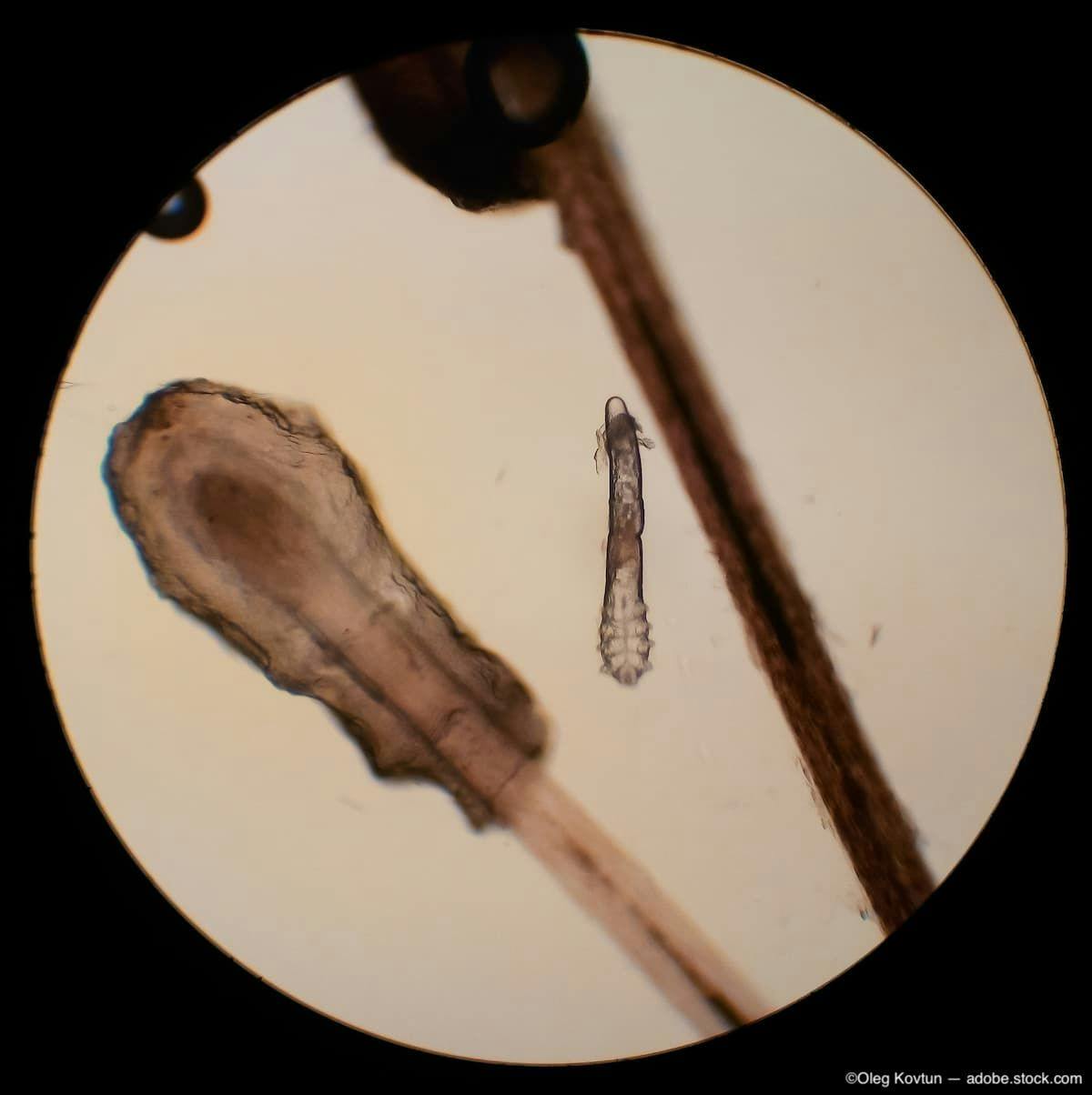 Demodex in eyelashes under microscope Image Credit: AdobeStock/OlegKovtun