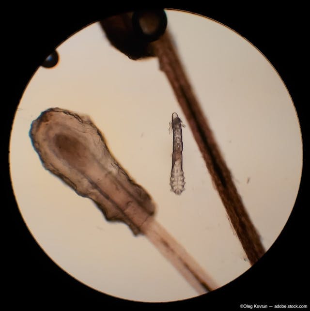 Demodex in eyelashes under microscope Image credit: ©Oleg Kovtun - adobe.stock.com
