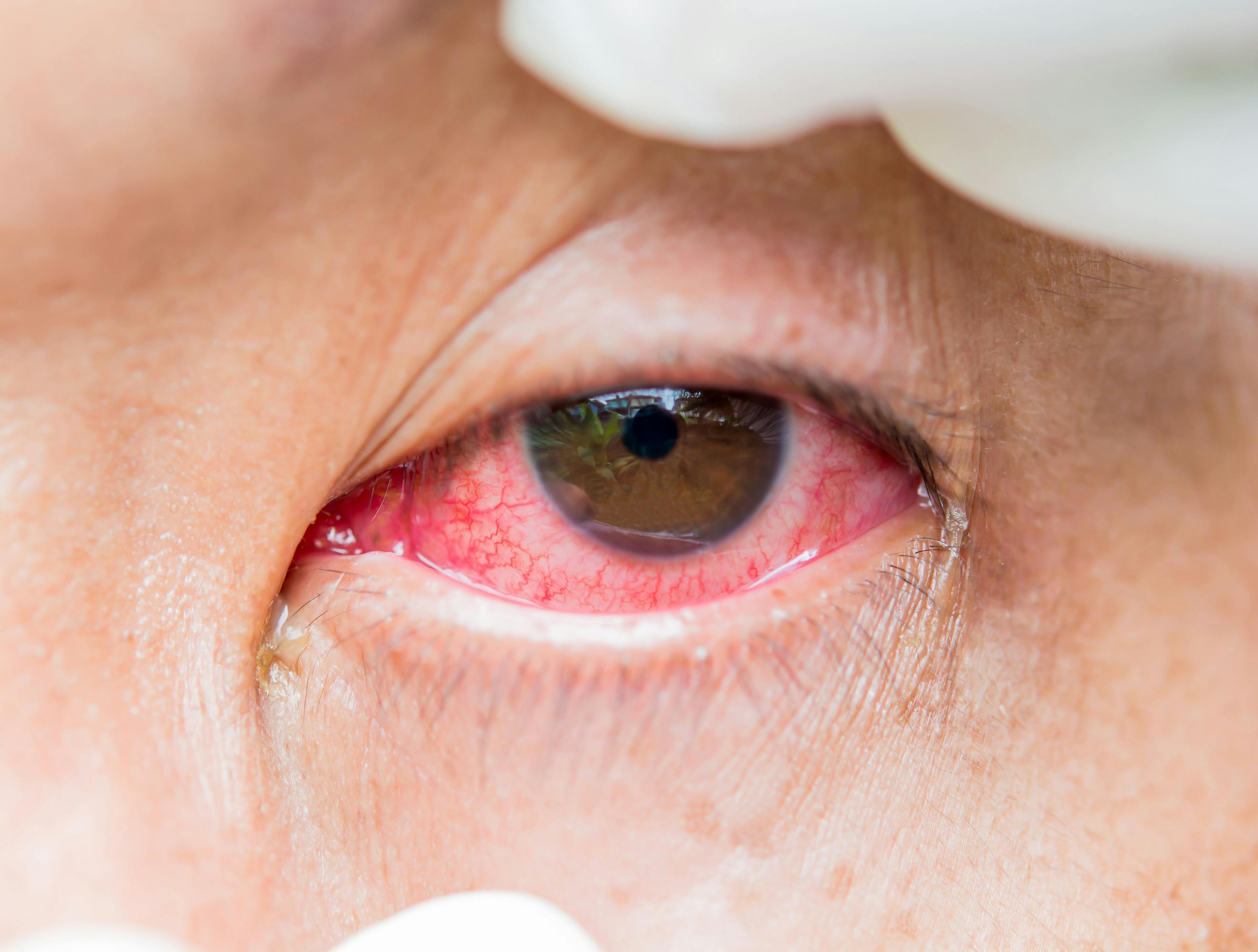 Treatment options for ocular allergies