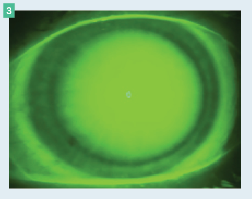 Figure 3. Limbal bearing seen in a 360° view.