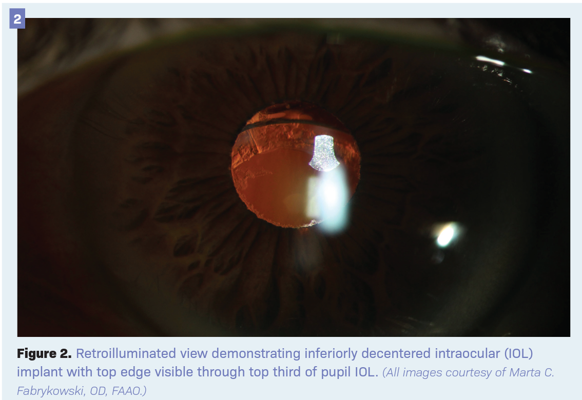 Figure 2. Retroilluminated view demonstrating inferiorly decentered intraocular (IOL) implant with top edge visible through top third of pupil IOL. (All images courtesy of Marta C. Fabrykowski, OD, FAAO.)