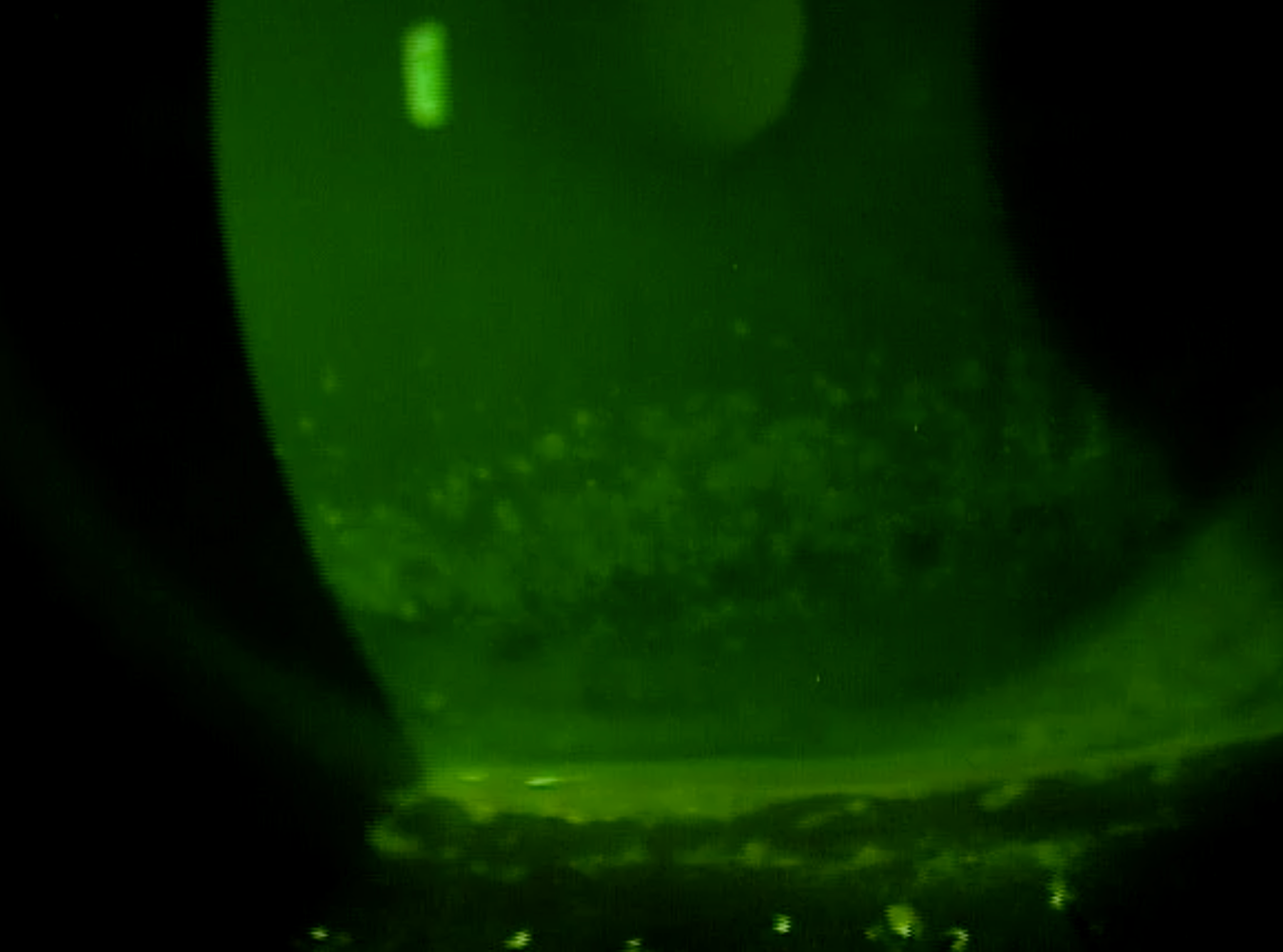 Slit lamp image showing potential signs of TED; patient should be referred to a TED specialist