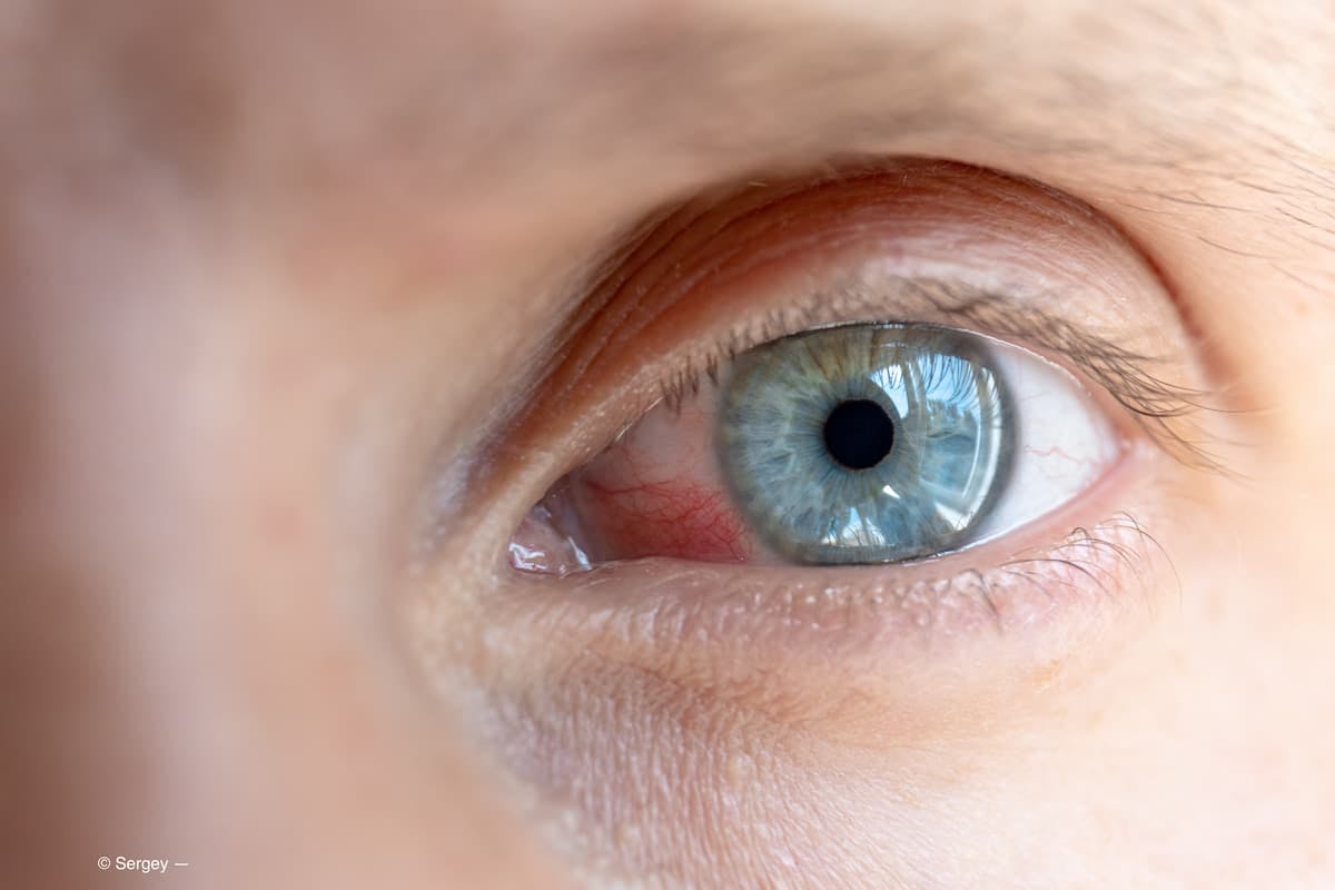 male inflamed eye with red capillaries (Adobe Stock / Sergey)