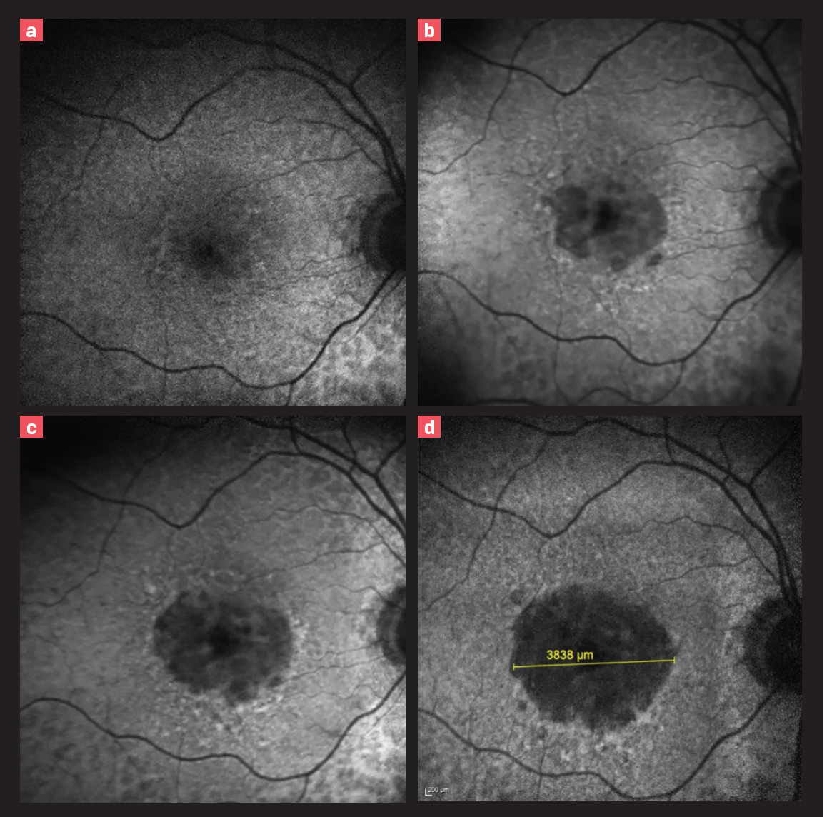 Figure 1. Fundus autofluorescence shows progression from no geography atrophy to a nearly 4000-µ lesion in a patient with age-related macular degeneration over a 5.5-year period, whose visual acuity changed from 20/30 to 20/300. (All images courtesy of Mohammad Rafieetary, OD, FAAO; Charles Retina Institute.)