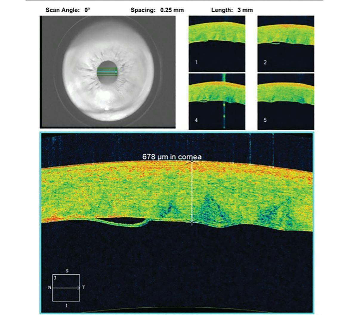 Comanaging tears in Descemet membrane during cataract surgery