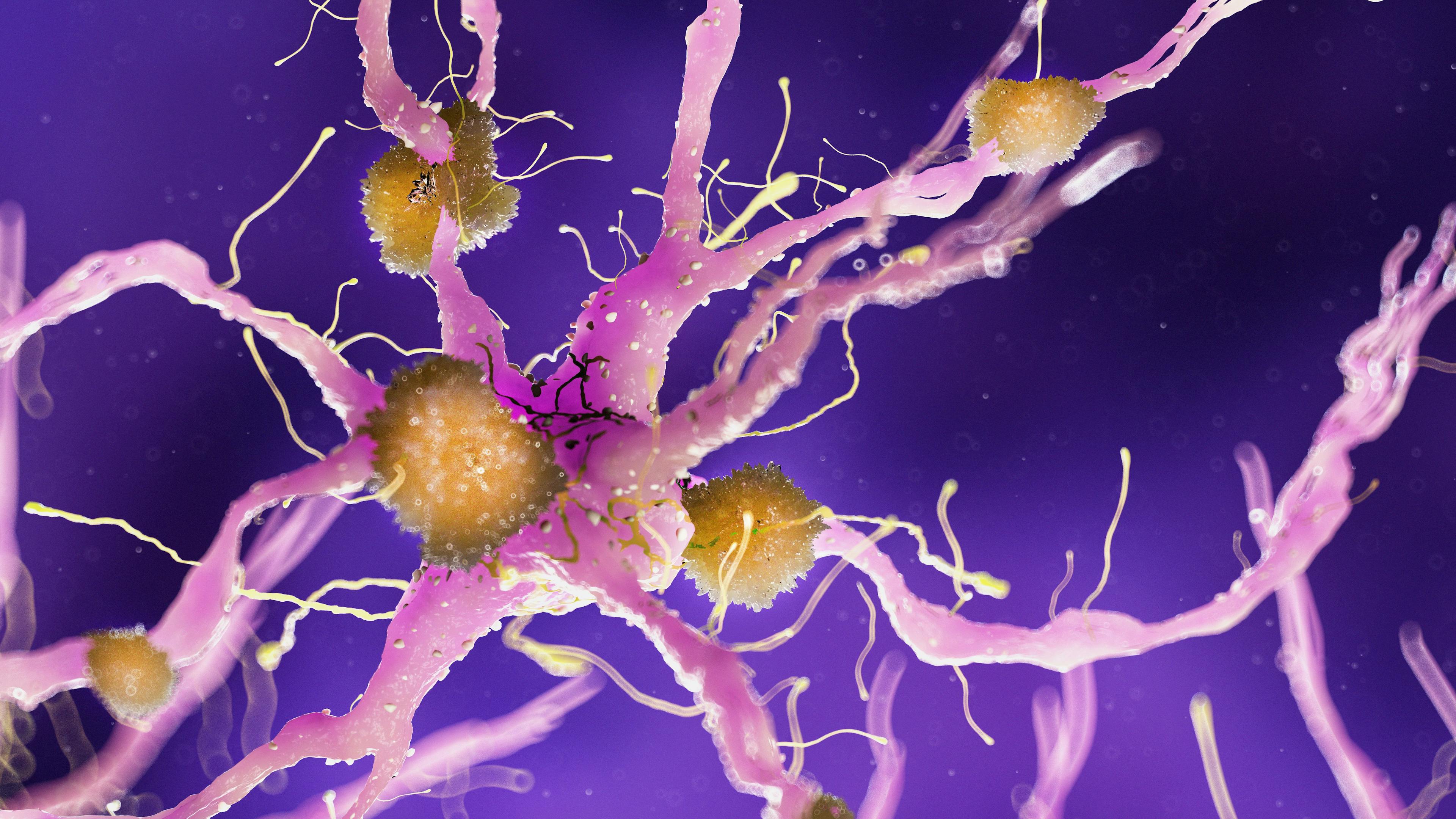 Plasma exchange with albumin could slow Alzheimer’s disease