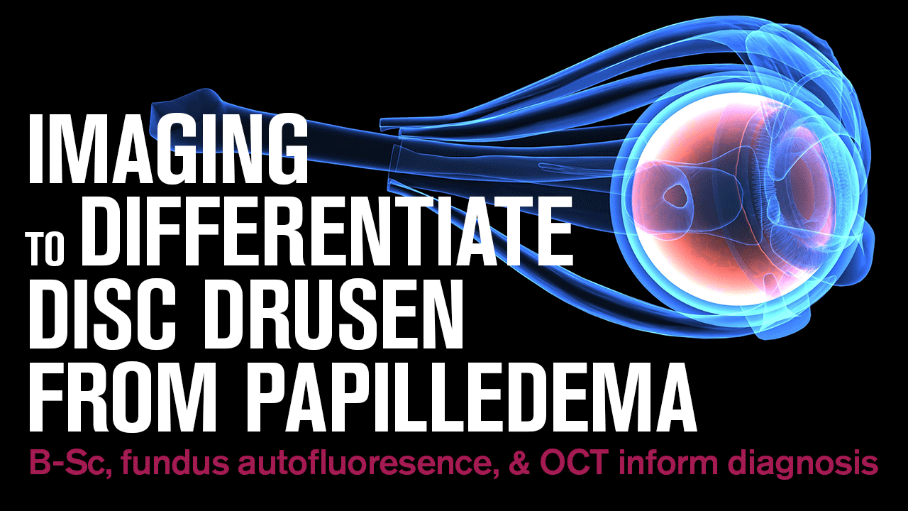 Imaging to differentiate disc drusen from papilledema