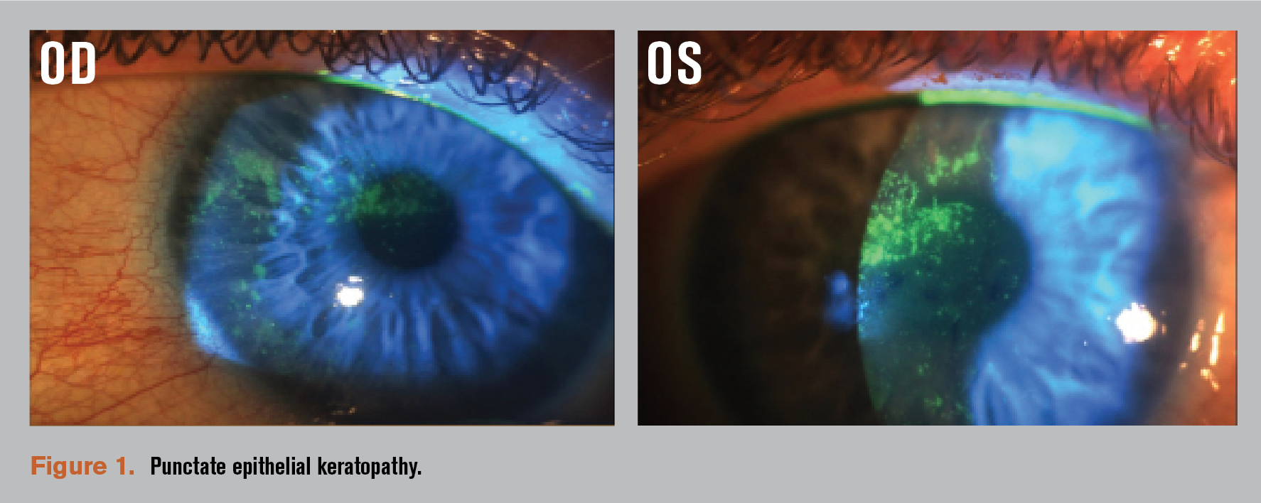 Case review of challenging ocular surface disease