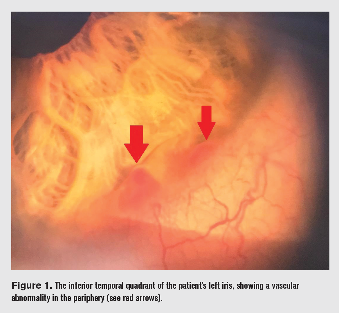 Case study: Vascular abnormality diagnosed as arteriovenous malformations of the iris