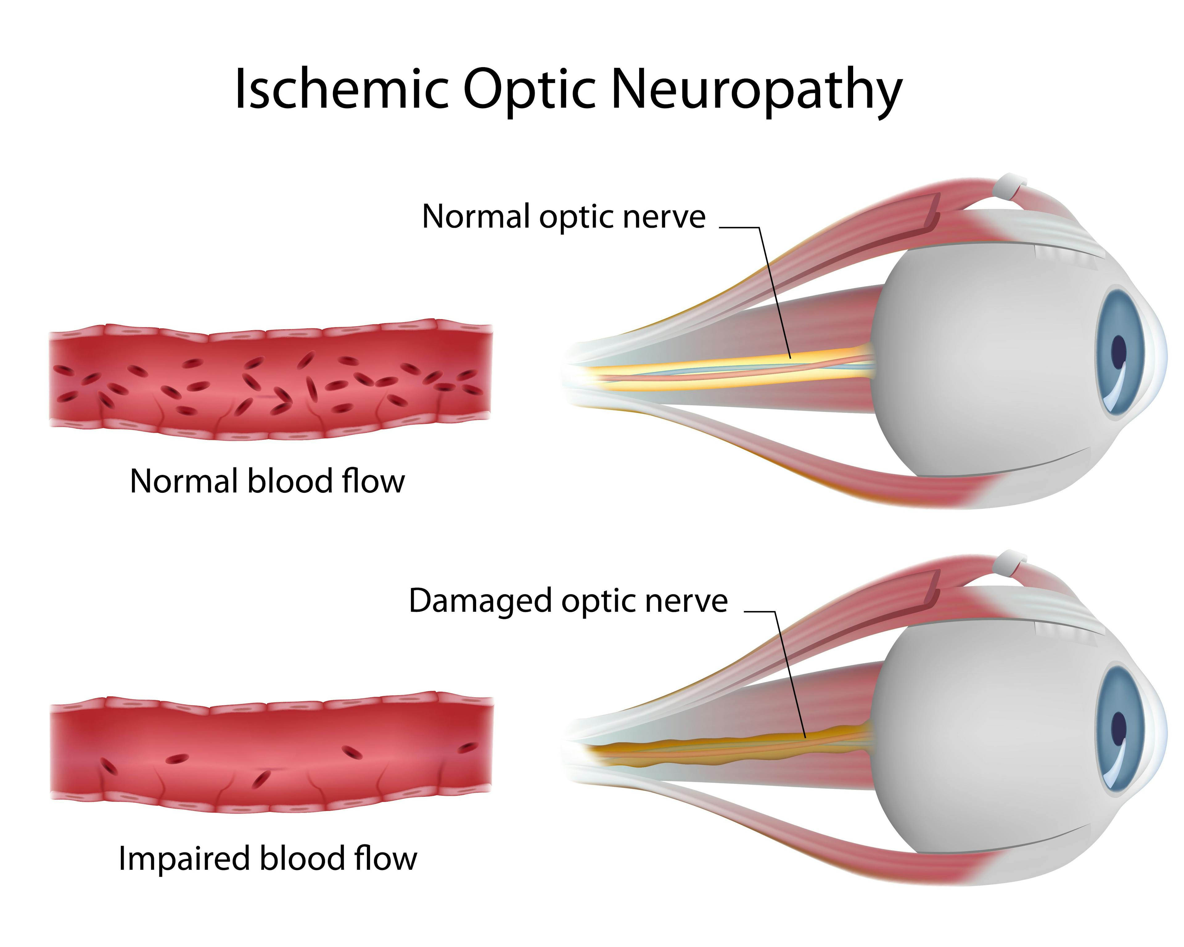 Optimizing ocular blood flow in glaucoma management